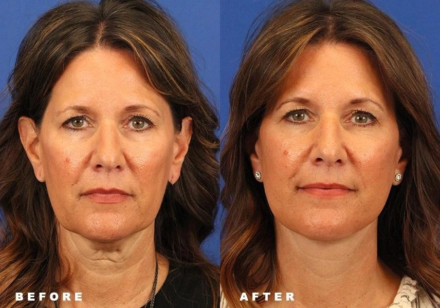 how much is rhinoplasty surgery