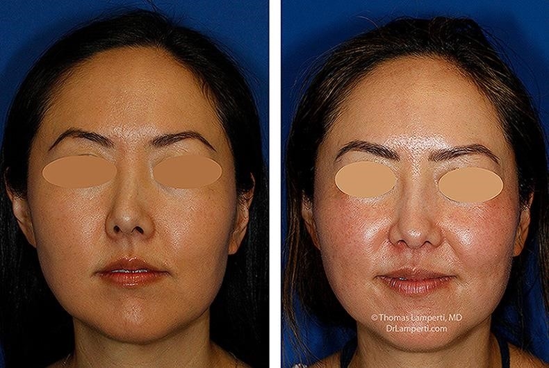 how much is rhinoplasty surgery